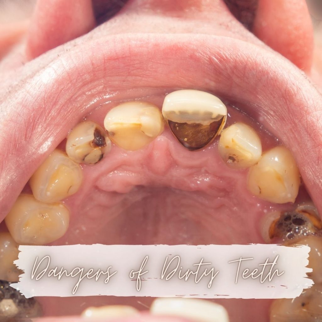 Dying of Dirty Teeth – Healthy Smiles Forever